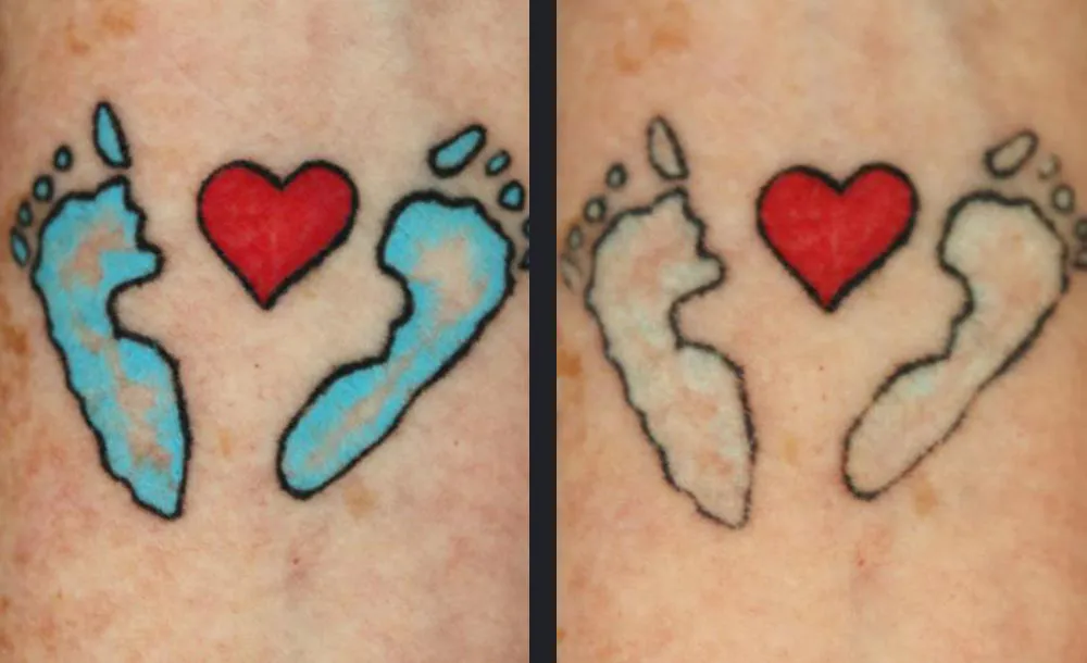 Candela PicoWay axcb