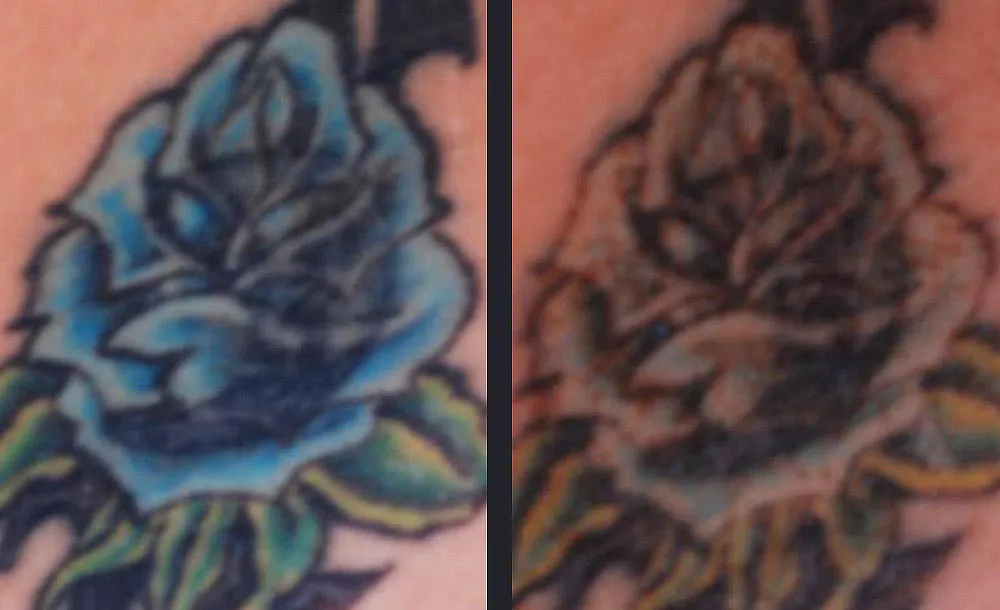 Candela PicoWay encl