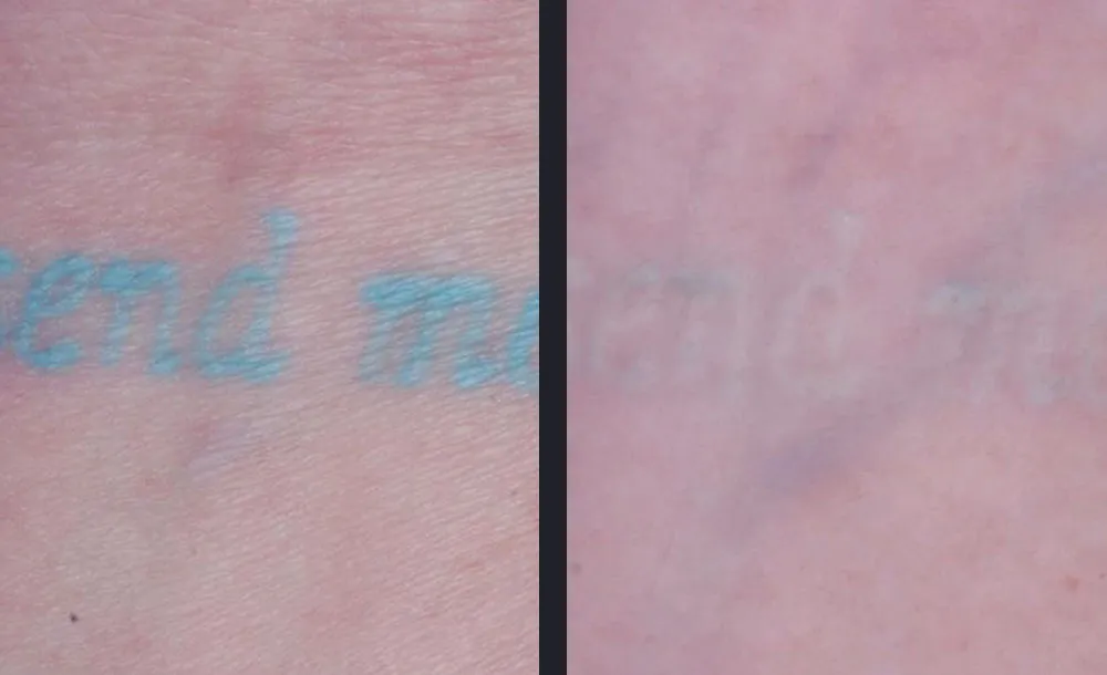 Candela PicoWay lylj