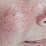 Inmode Morpheus8 Portable 2 in 1 bwst Inmode Morpheus8 Portable 2 in 1 bwst