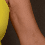 Inmode Morpheus8 Portable 2 in 1 eskn Inmode Morpheus8 Portable 2 in 1 eskn