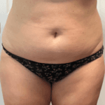 Inmode Morpheus8 Portable 2 in 1 eskt Inmode Morpheus8 Portable 2 in 1 eskt