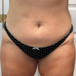 Inmode Morpheus8 Portable 2 in 1 hmwk Inmode Morpheus8 Portable 2 in 1 hmwk