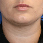 Inmode Morpheus8 Portable 2 in 1 ivsp Inmode Morpheus8 Portable 2 in 1 ivsp