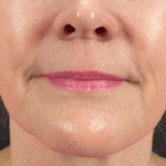 Inmode Morpheus8 Portable 2 in 1 mydk Inmode Morpheus8 Portable 2 in 1 mydk