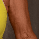 Inmode Morpheus8 Portable 2 in 1 oulm Inmode Morpheus8 Portable 2 in 1 oulm