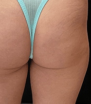 Inmode Morpheus8 Portable 2 in 1 ytvh Inmode Morpheus8 Portable 2 in 1 ytvh