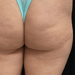 Inmode Morpheus8 Portable 2 in 1 ywxm Inmode Morpheus8 Portable 2 in 1 ywxm