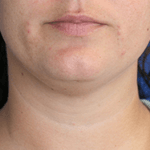 Inmode Morpheus8 Portable 2 in 1 qrdc Inmode Morpheus8 Portable 2 in 1 qrdc