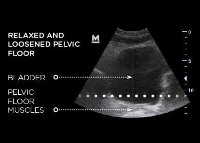 EMSELLA evkn EMSELLA evkn