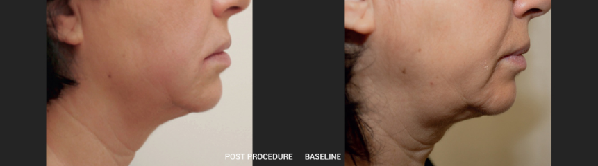 Clinical Outcomes 4232