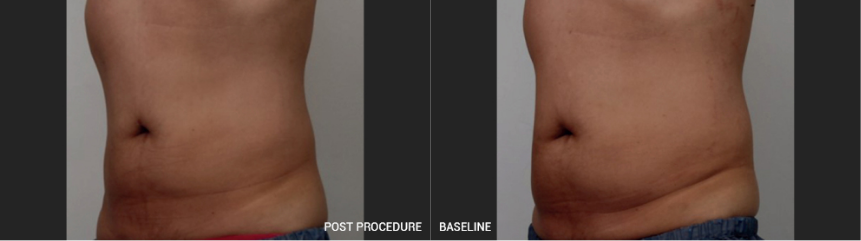 Clinical Outcomes 4233