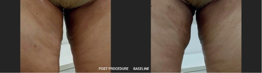 Clinical Outcomes 4234