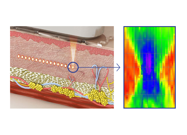 Lift, Tighten, and Contour with Micro & Macro Focused ultrasound 4225