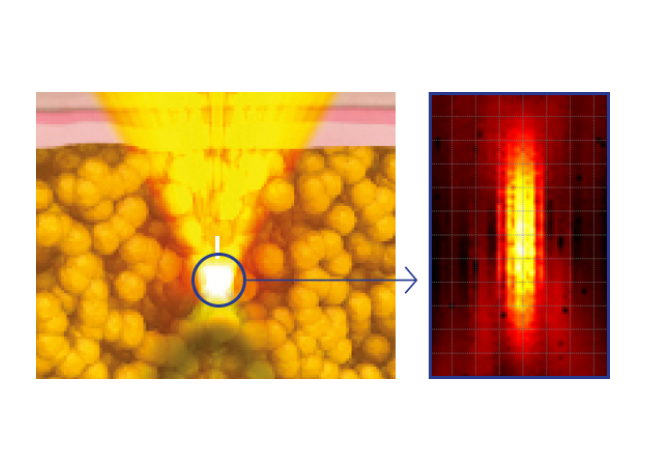 Lift, Tighten, and Contour with Micro & Macro Focused ultrasound 4226